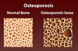 Kyphoplasty / Vertebroplasty